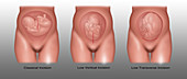 Caesarean Incision Types, Illustration