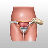 Cesarean Section Incisions, Illustration