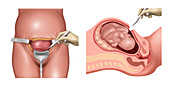 Cesarean Section Incisions, Illustration