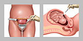 Cesarean Section Incisions, Illustration