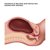 Cesarean Section Steps, Illustration, 4 of 4