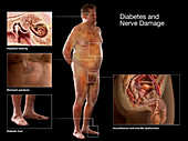 Diabetes and Nerve Damage