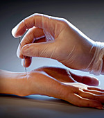 Acupuncture and Diabetes
