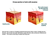 Psoriasis and eczema, infographic