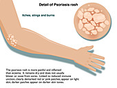 Psoriasis rash, infographic