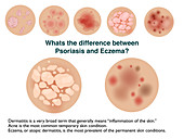 Psoriais compared eczema, infographic