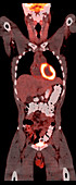Normal PET CT Scan of Adult Male