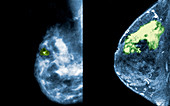 Breast Cancer, Mammogram vs. MRI