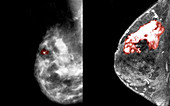 Breast Cancer, Mammogram vs. MRI