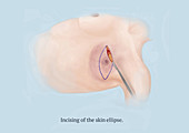 Mastectomy, Step 3 of 8, Illustration
