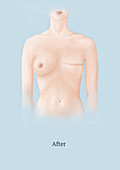 After Mastectomy, Step 8 of 8, Illustration