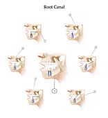 Root Canal Procedure, Illustration