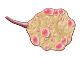 Polycystic Ovaries, Illustration
