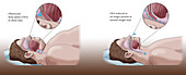 Obesity and Sleep Apnea, Illustration