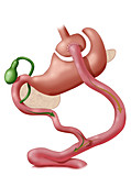 Roux-en-Y Gastric Bypass Surgery, Illustration