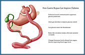 Gastric Surgery for Diabetes