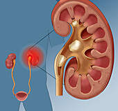Kidney Stone Pain, Illustration