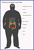 Cancer Risks of Obesity, Illustration