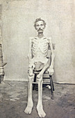 American Civil War, Emaciated Union POW, 1865