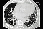 Asbestosis, CT scan
