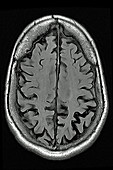 Cerebral atrophy, MRI