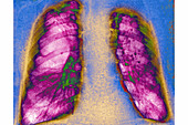 Pulmonary emphysema, X-ray