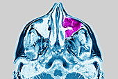 Maxillary sinusitis, MRI