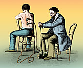 Cupping Therapy, 1862