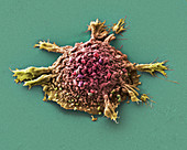 Lung cancer cell, SEM