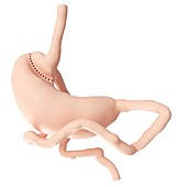 Illustration of a gastric bypass