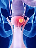 Illustration of bladder cancer