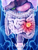 Illustration of intestine cancer