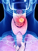 Illustration of larynx cancer