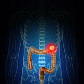 Illustration of colon cancer