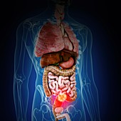 Illustration of colon cancer