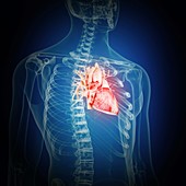 Illustration of an inflamed heart