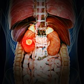 Illustration of kidney cancer