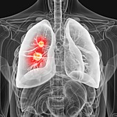 Illustration of lung cancer