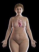 Illustration of an obese woman's heart