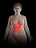 Illustration of an obese woman's painful stomach