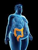 Illustration of an obese man's colon