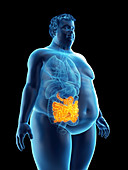 Illustration of an obese man's intestine