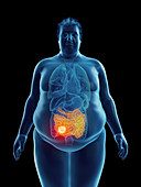 Illustration of an obese man's intestine tumor
