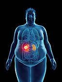 Illustration of an obese man's kidney tumor