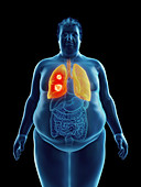 Illustration of an obese man's lung tumor