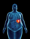 Illustration of an obese man's spleen tumor