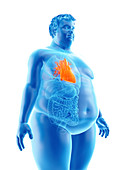 Illustration of an obese man's heart