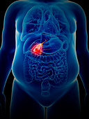 Illustration of gallbladder cancer