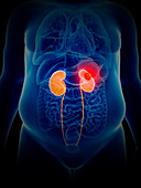 Illustration of kidney cancer