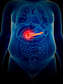 Illustration of pancreas cancer